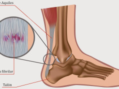 Lesiones en pádel: Tendinitis en el tendón de Aquiles Tendinitis en el tendón de Aquiles