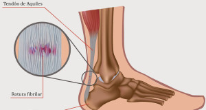 Tendinitis en el tendón de Aquiles