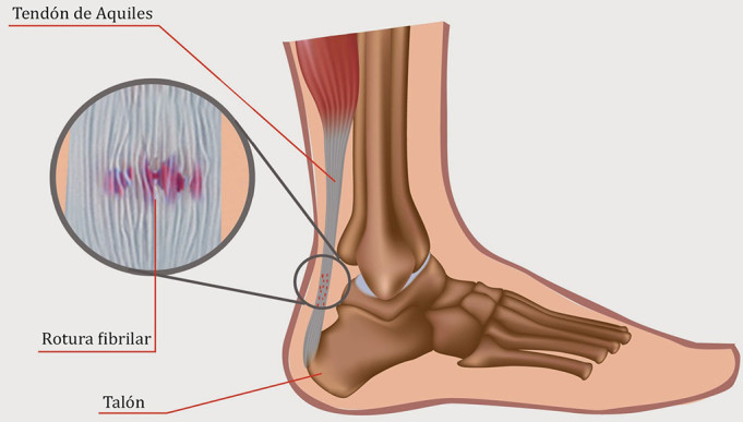 Lesiones en pádel: Tendinitis en el tendón de Aquiles Tendinitis en el tendón de Aquiles